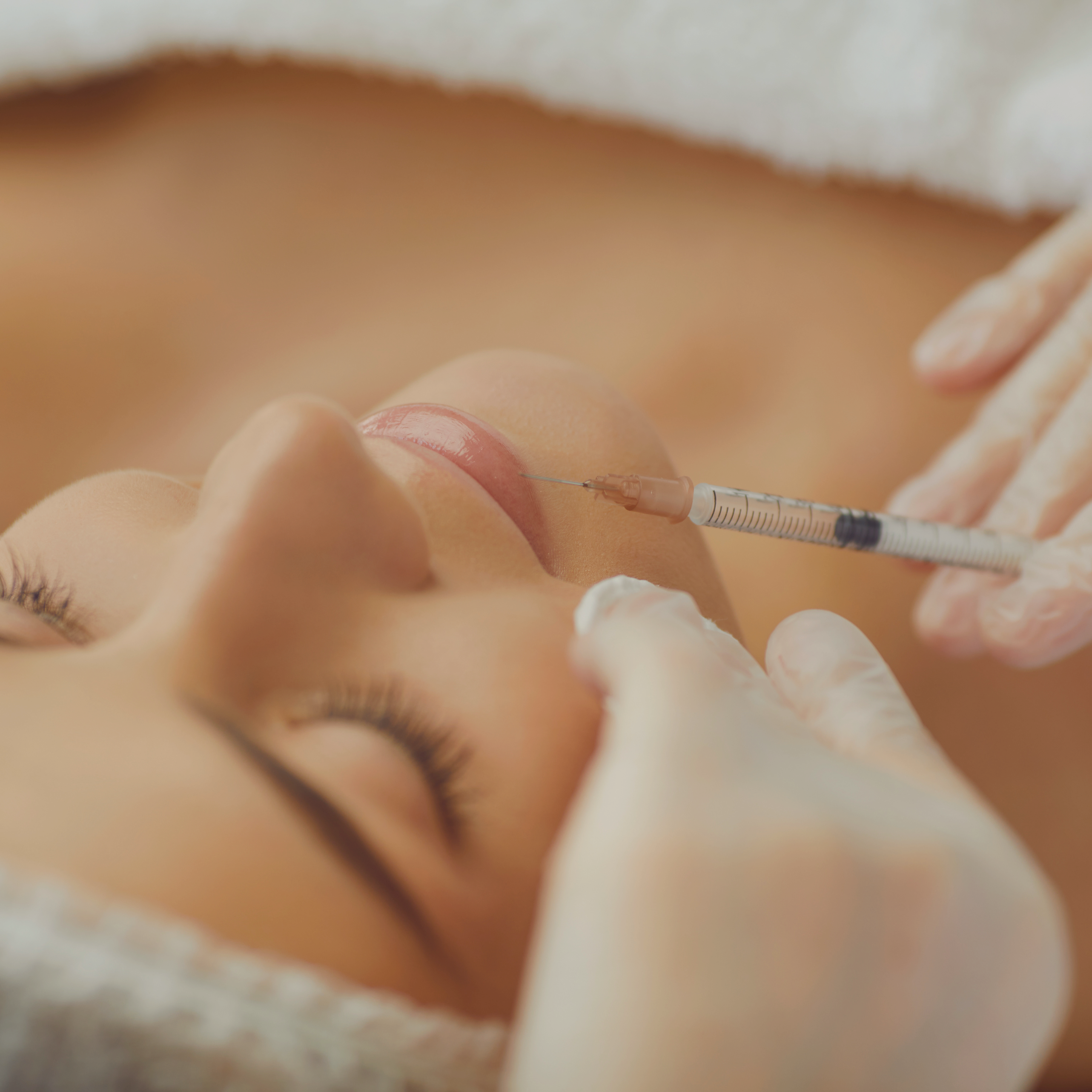 Trattamento filler labbra con acido ialuronico